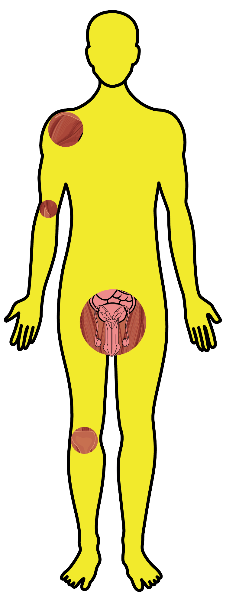 Brucelose - Desenho corpo